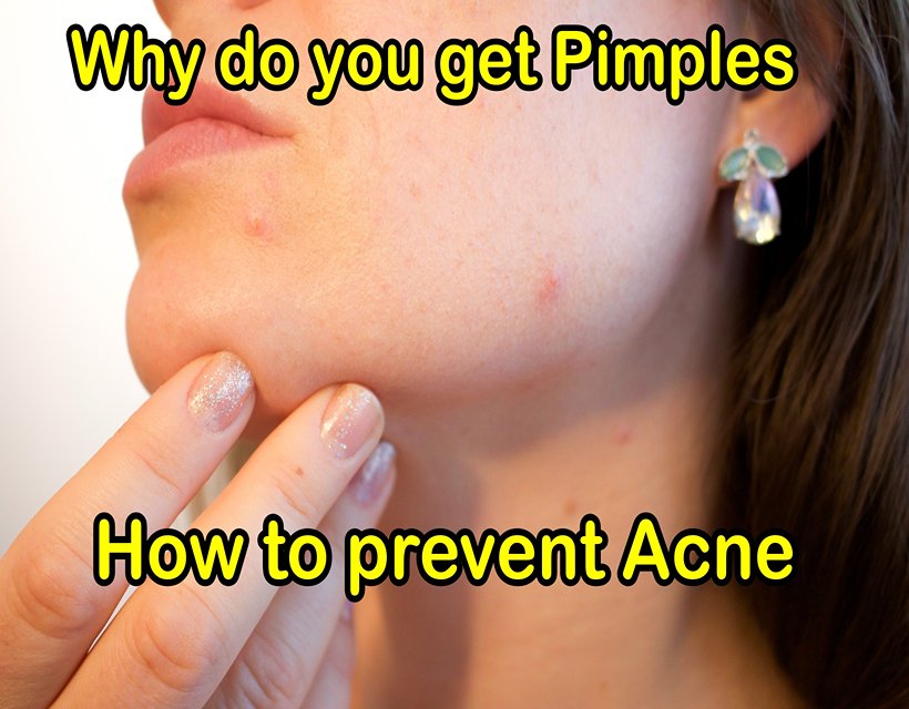 Why do you get Pimples - How to prevent Acne